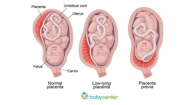 Placenta praevia : quand la malposition du placenta devient une complication de grossesse 4